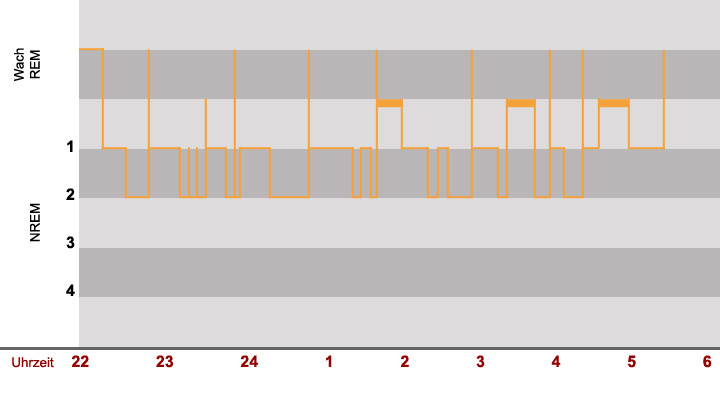 Diagramm für Schlafstadien bei Schlafapnoe